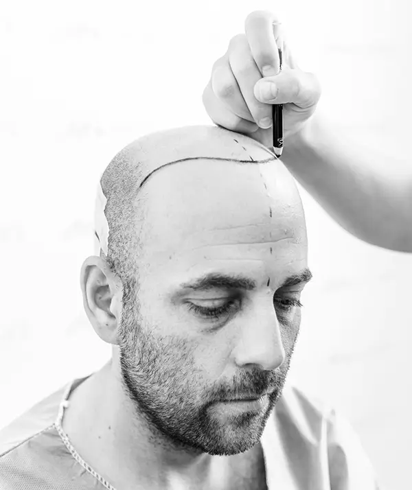 Implantácia vlasov